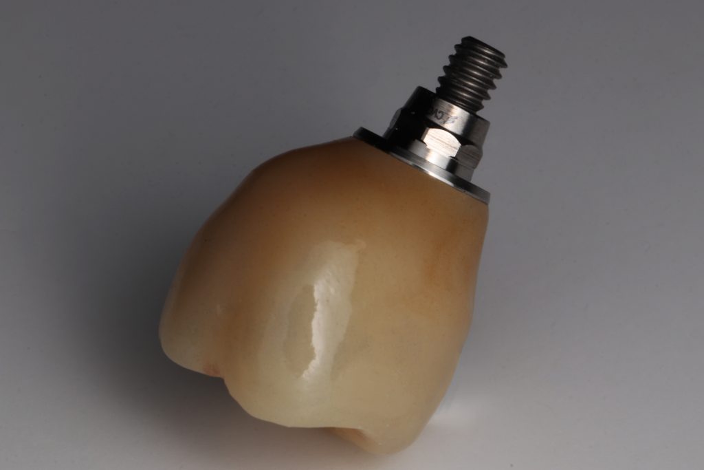 dental implants