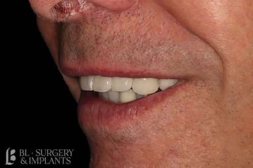 before and after dental implants